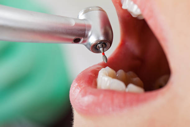 Best Lost Filling or Crown Replacement in Des Allemands, LA